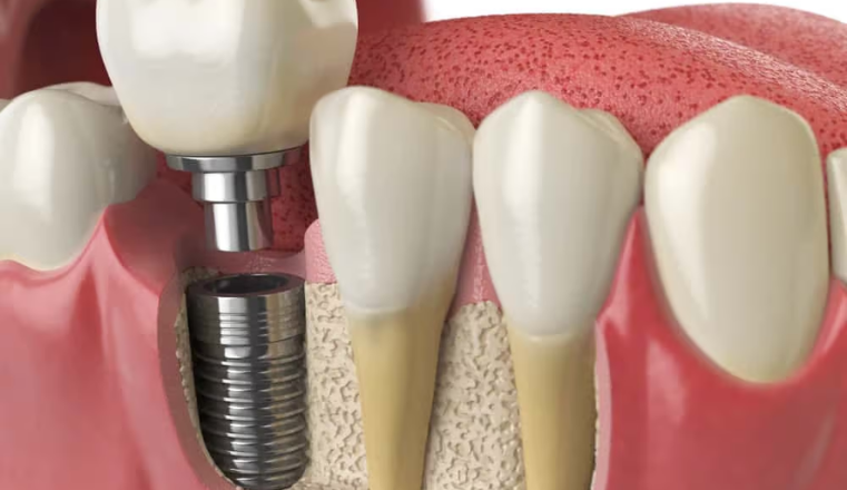 Replacement of Teeth